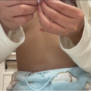 乳钉yin chun上钉手术实拍：完美美容体验